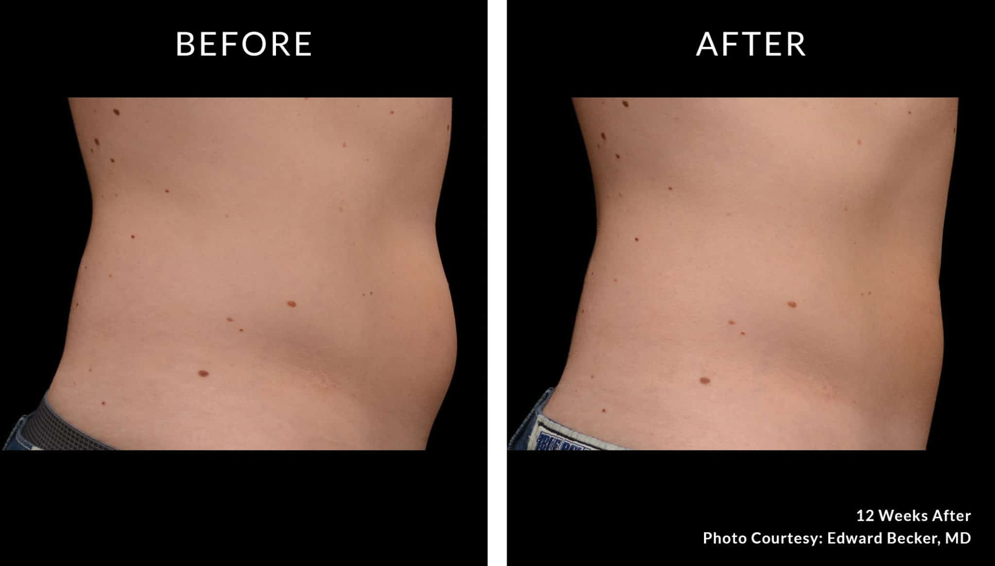 Coolsculpting Bodysculpt Hawaii Specializing in Emsculpt and