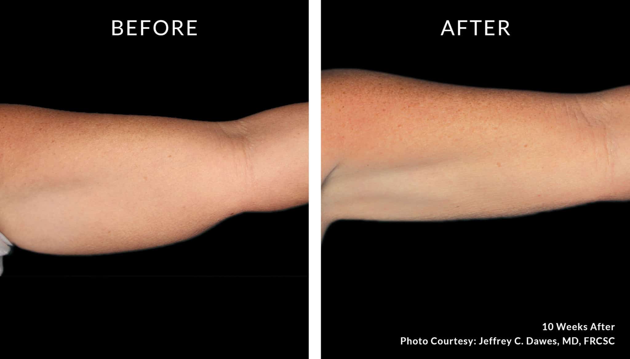 Coolsculpting Bodysculpt Hawaii Specializing in Emsculpt and