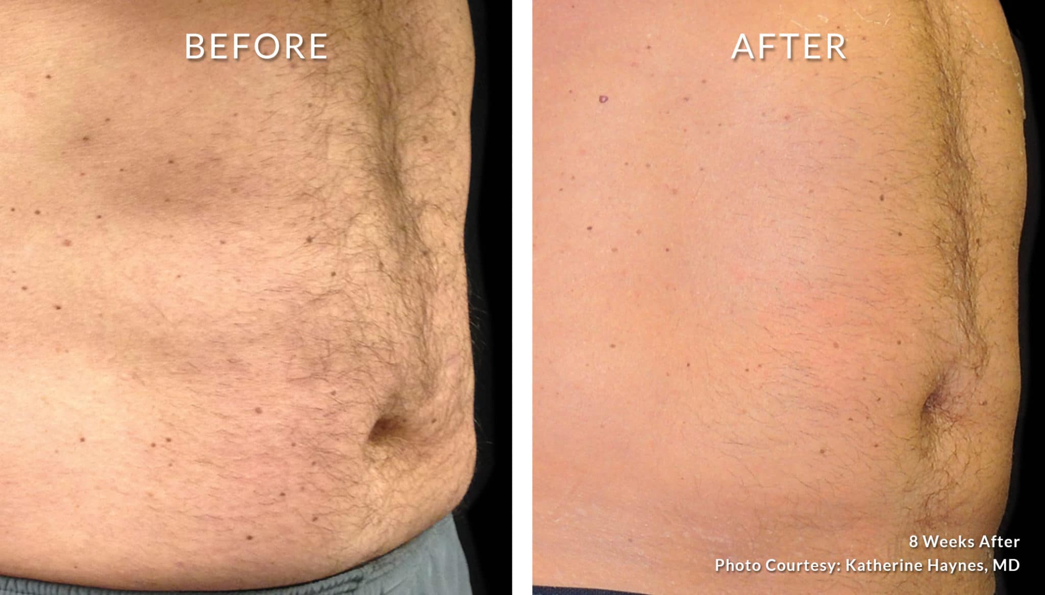 Coolsculpting Bodysculpt Hawaii Specializing in Emsculpt and