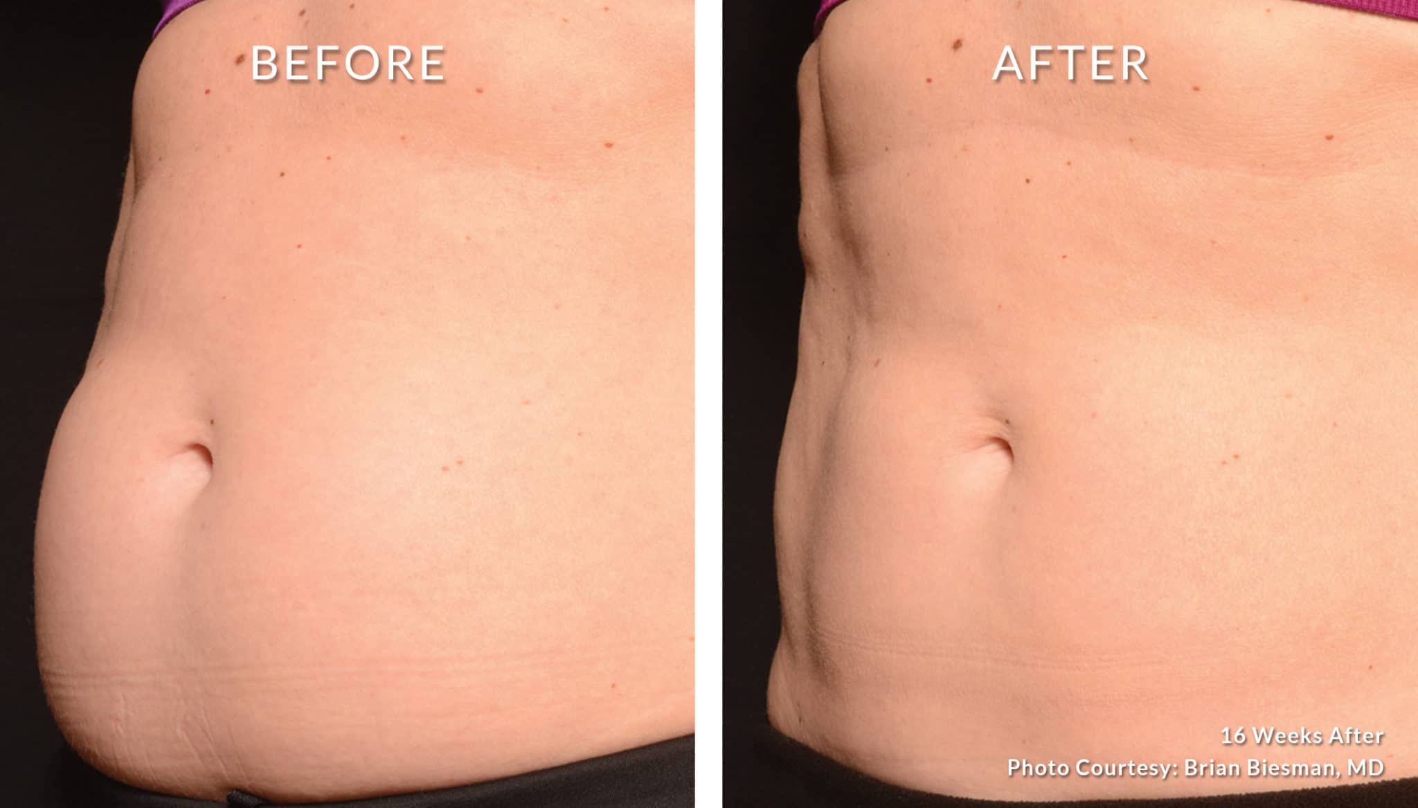 Coolsculpting Bodysculpt Hawaii Specializing in Emsculpt and